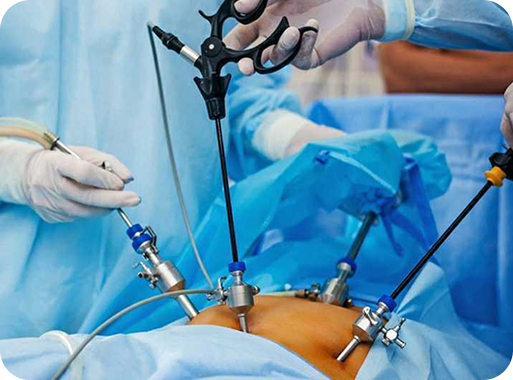 Laparoscopy: A Minimally Invasive Solution for Gynecological Issues